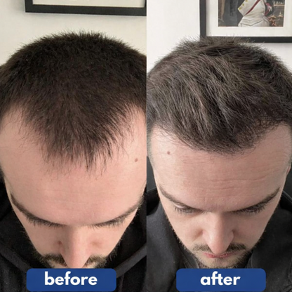 Hair Regrowth Serum